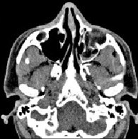 Nose and slide sinuses