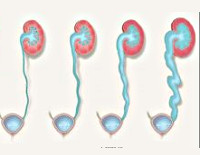 Bubble ureter reflux