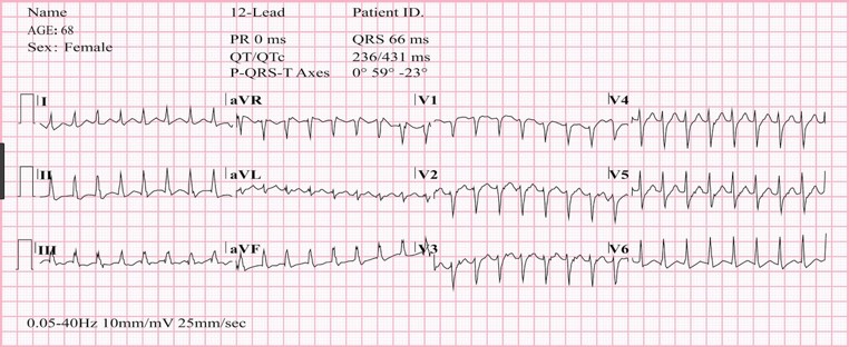 Paroxysm of supraventricular tachycardia with a frequency of 180 per minute