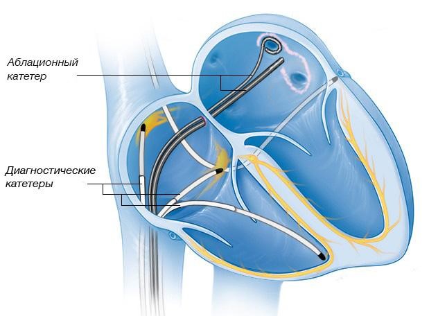 Location of catheters in the heart during RFA