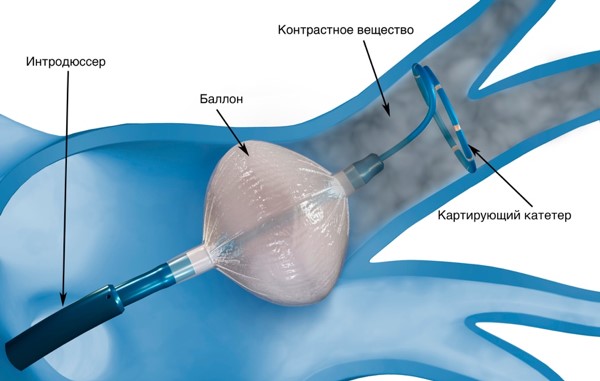 Location of the balloon in the left atrium during cryoablation