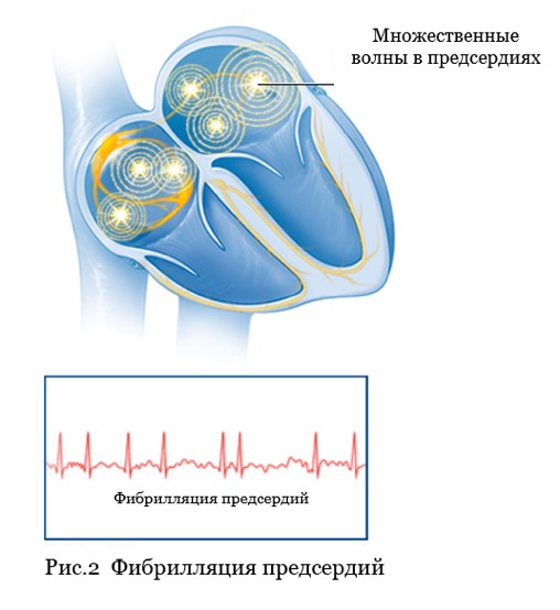 Atrial fibrillation