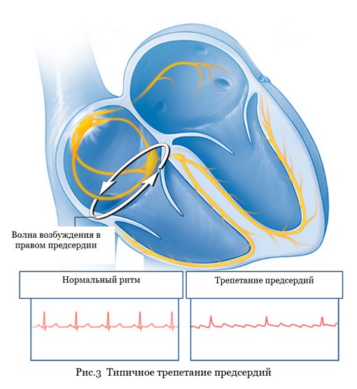 Typical atrial flutter