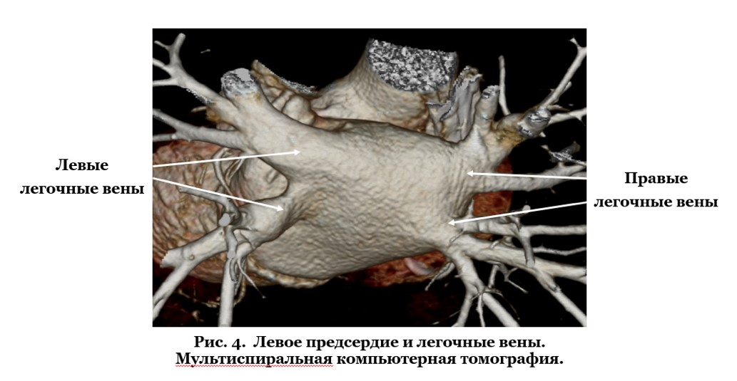 Left atrium and pulmonary veins. Multislice computed tomography