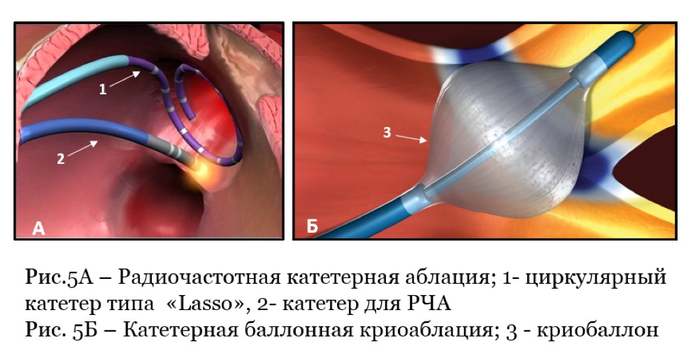 Radiofrequency catheter ablation (RFA)