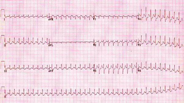 Paroxysm of AV nodal tachycardia on ECG