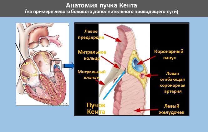 Kent's bundle of left lateral localization