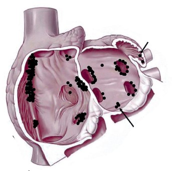 Sources of atrial tachycardia in the left atrium