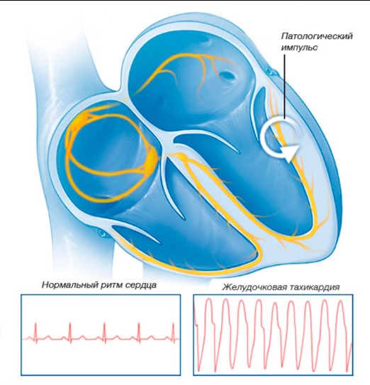 Ventricular tachycardia