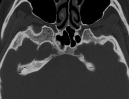 Study of temporal bone