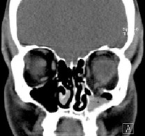 Nose and slide sinuses