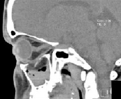 Nose and slide sinuses