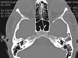 Study of temporal bone