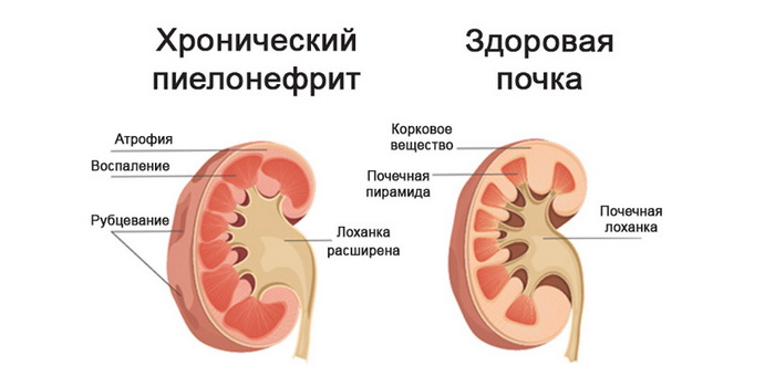 Pyelonephritis in women - causes, symptoms and treatment