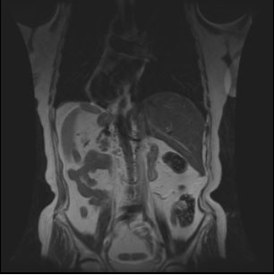 MRI abdominal cavity