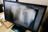 The Ministry of Health reported a decrease in the incidence of tuberculosis in the Kaliningrad region