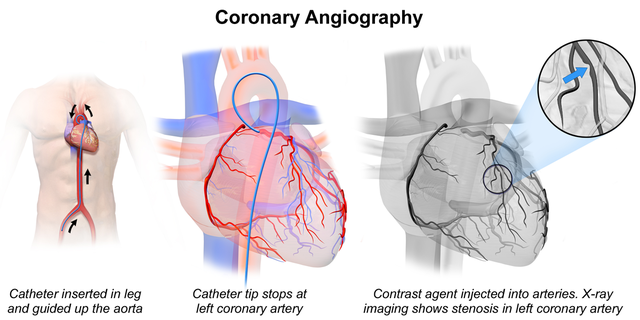 coronary angiography