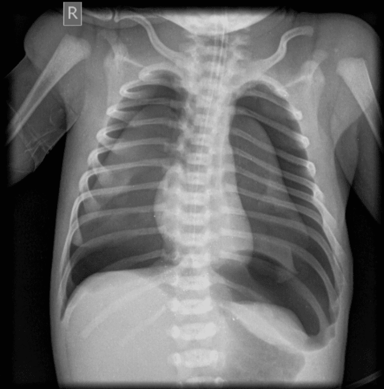 Neonatal pneumothorax