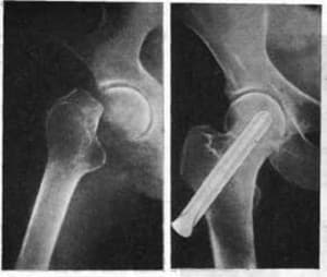 What is a consolidated fracture - image 1