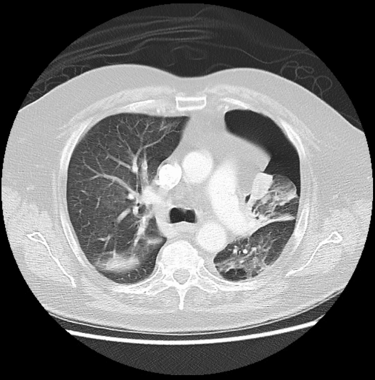 Left-sided pneumothorax