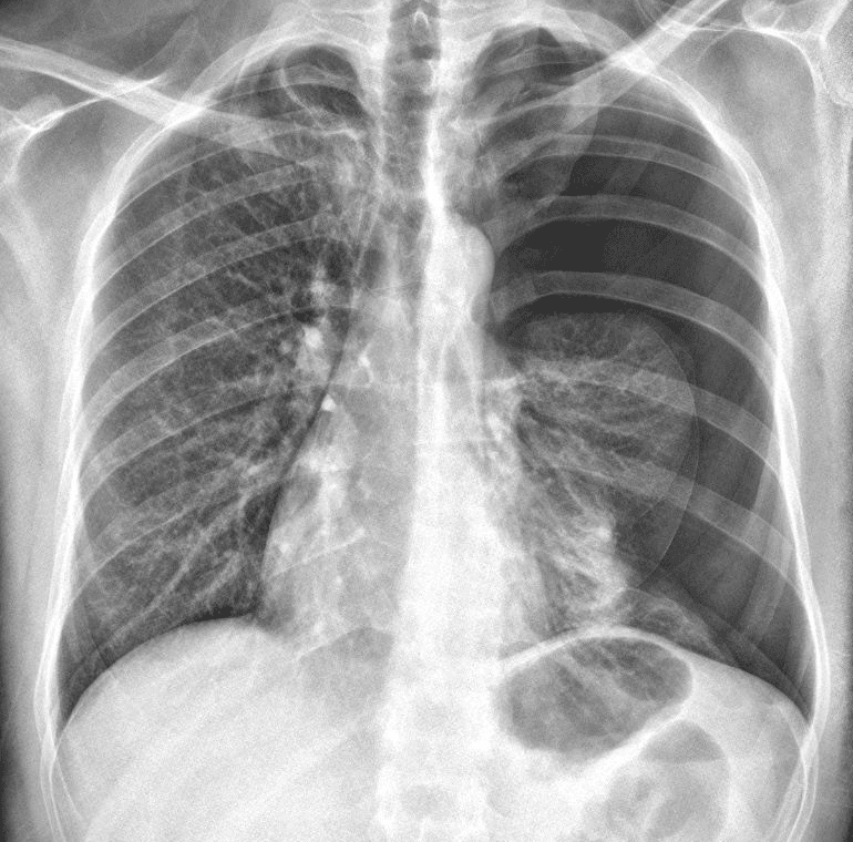 Pneumothorax with a partial collapse of the left lung.