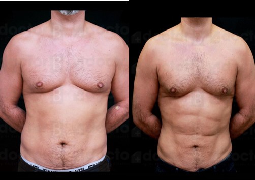 liposuction in turkey