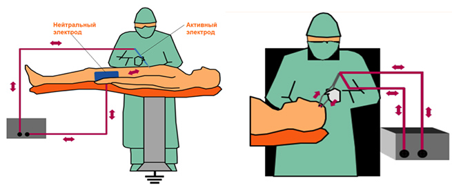 Choosing an electrocoagulator-1