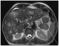 damage to the liver and para-aortic lymph nodes
