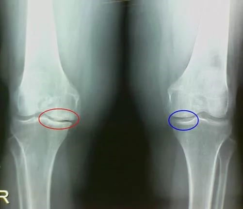 Inflammatory processes in the articular tissues