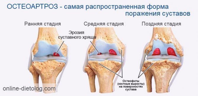 Artradol. A domestic remedy that improves metabolic processes in tissues, restores, hinders destructive processes that affect connective tissue.