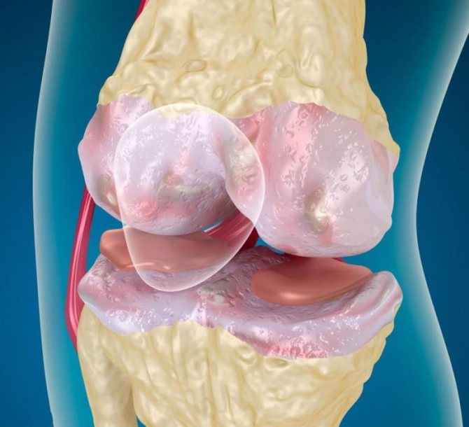 Inflammation of the cartilage tissue of the joints, its destruction, is associated with various adverse factors, as a result of which the cartilage becomes loose in structure, similar to a porous sponge. Its structure becomes rough, begins to dry out and cracks appear on it.